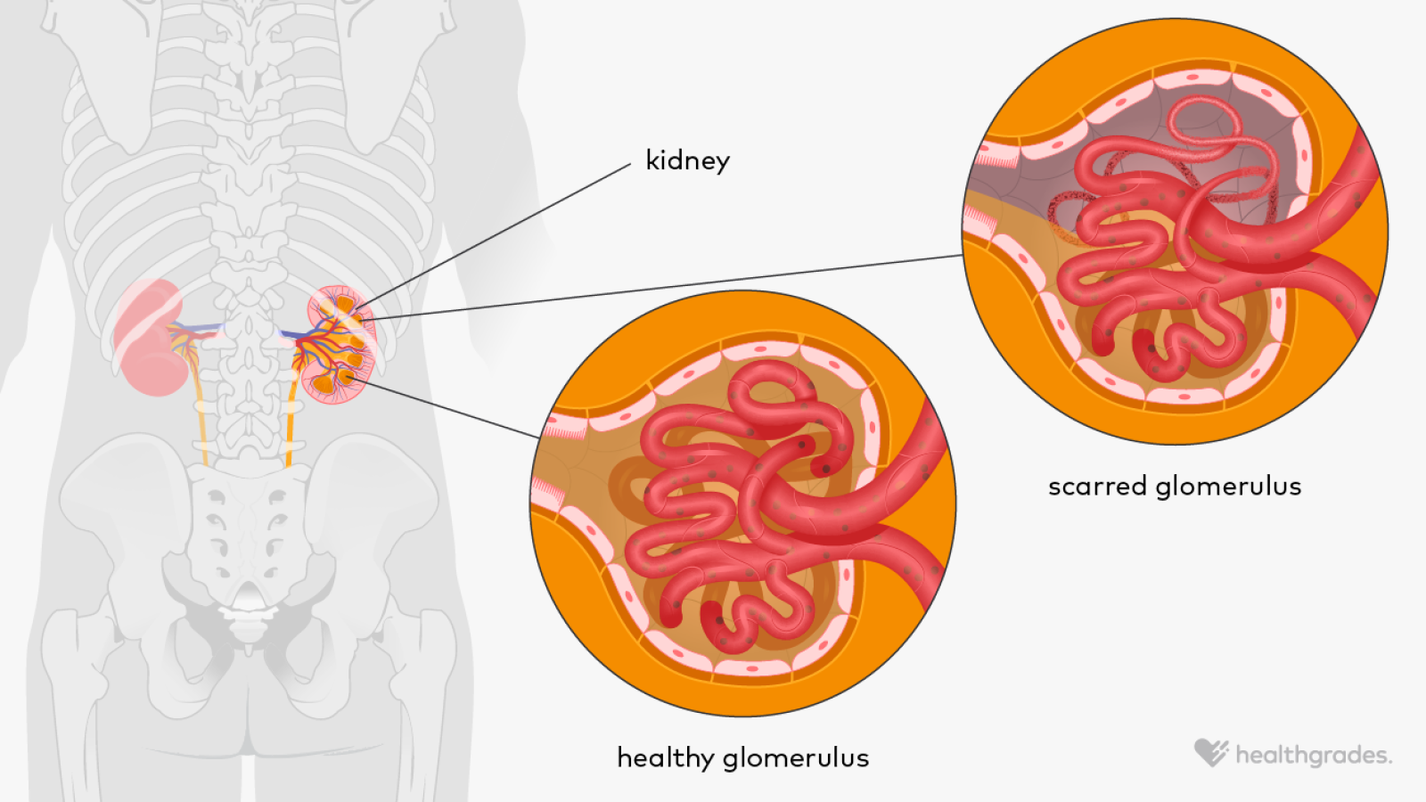 Focal Segmental Glomerulosclerosis: Symptoms, Treatments, and Outlook
