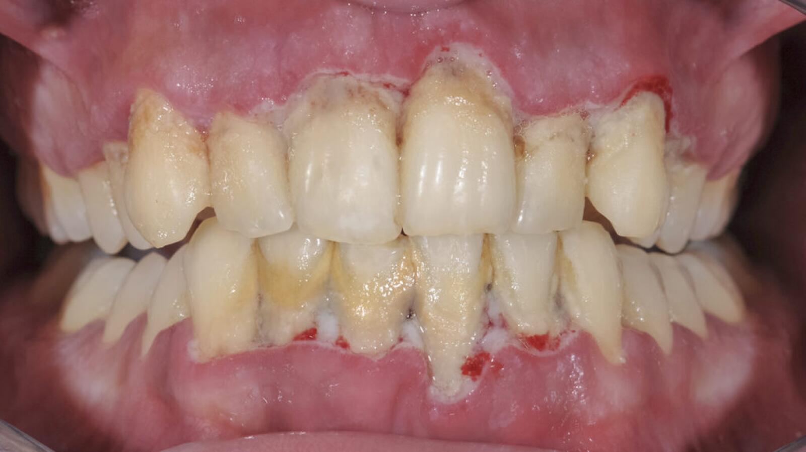 swollen gum calculus buildup