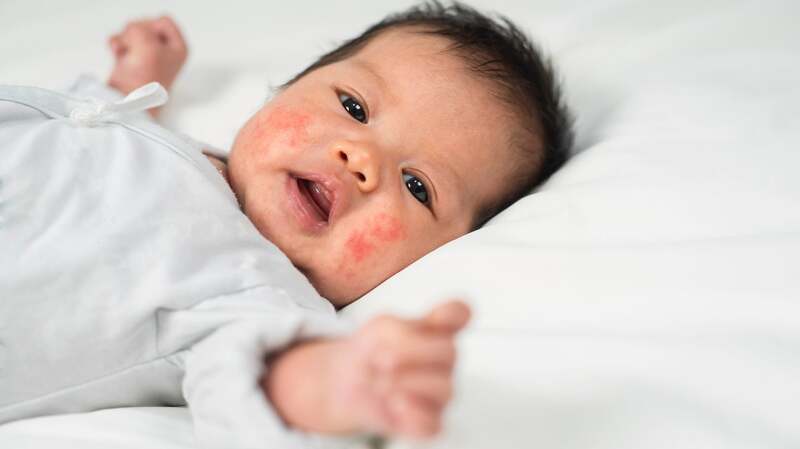 A medical image of atopic dermatitis.
