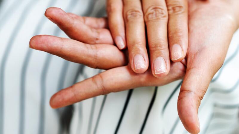 Dyshidrotic Eczema: Symptoms, Causes, and More Dyshidrotic Eczema: Symptoms, Causes, and More
