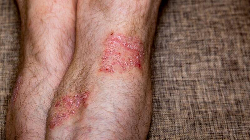 painful rash on lower leg