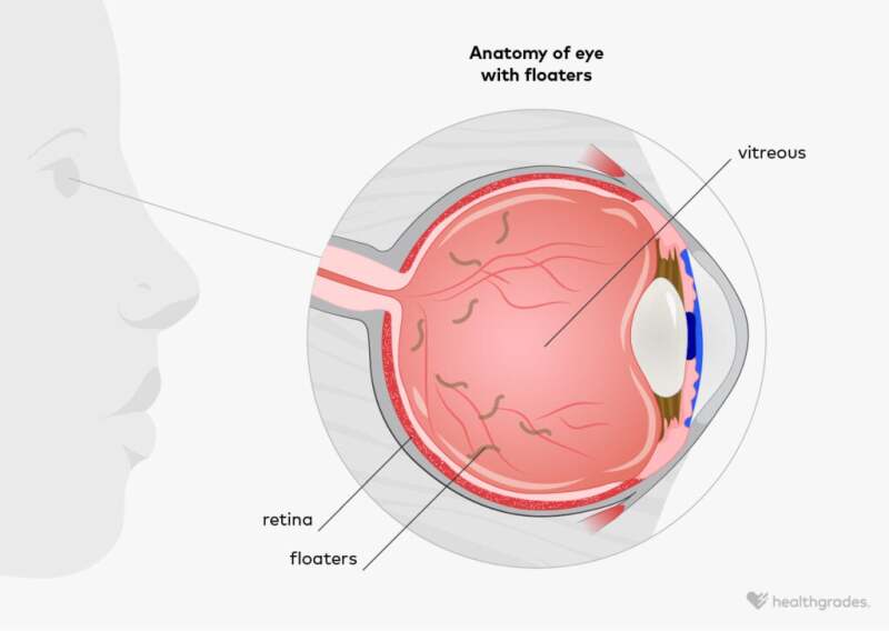 Eye Floaters: Symptoms, Causes, Treatments, and More