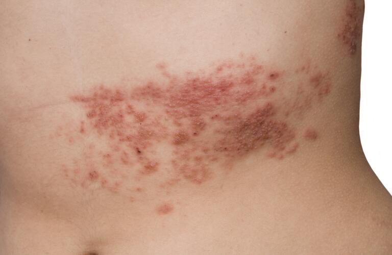 shingles (herpes zoster) on female abdomen 