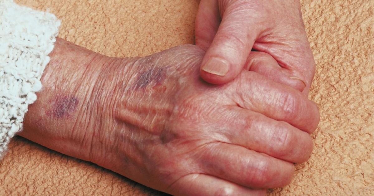 Purple Skin Symptoms Causes Treatments