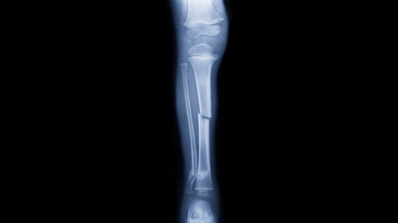 X-ray image of a broken tibia or shinbone