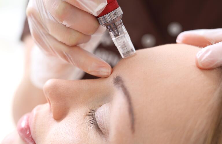 woman receiving microneedling with a mesotherapy needle at an aesthetic spa or dermatologist office
