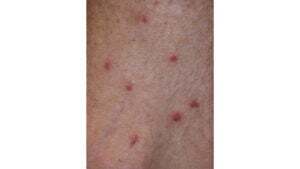 1-bug-bites-5-300x169.jpg