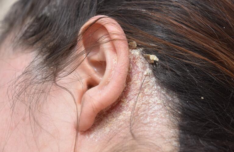Ear Psoriasis Psoriasis on the Ears
