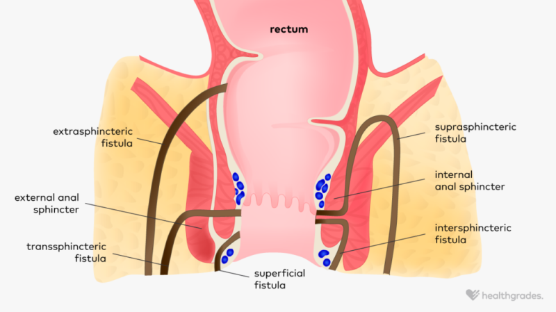 Medical illustration of types of anal fistula by Mekhi Baldwin