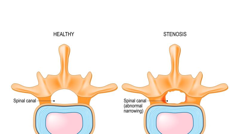 Spinal Stenosis 8 Things Doctors Want You To Know 3280