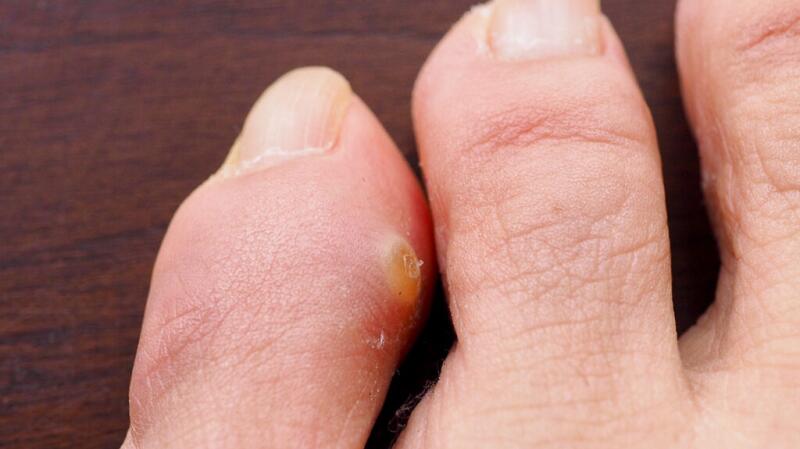 Why do we get Calluses on our hands and feet?