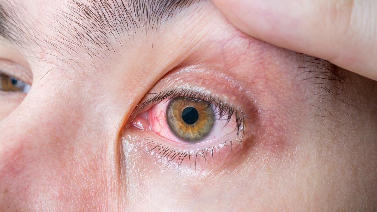 enlarged blood vessel in eye
