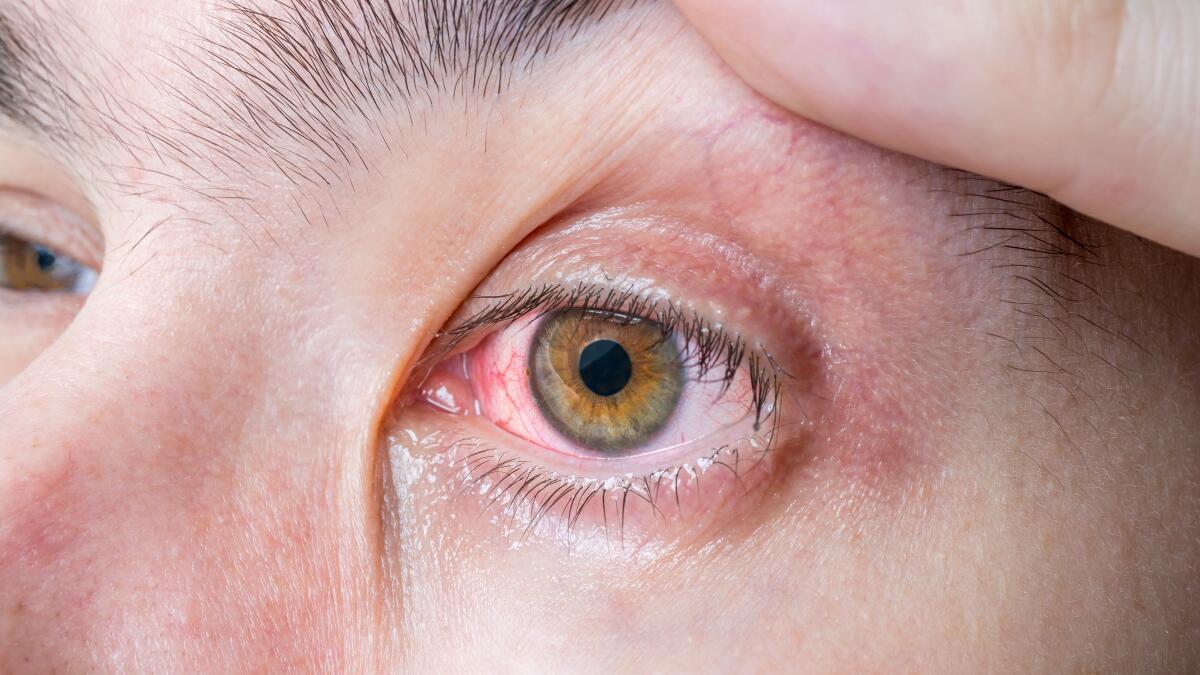Red Eyes: Causes, Treatments & When to See a Doctor | Bloodshot Eyes
