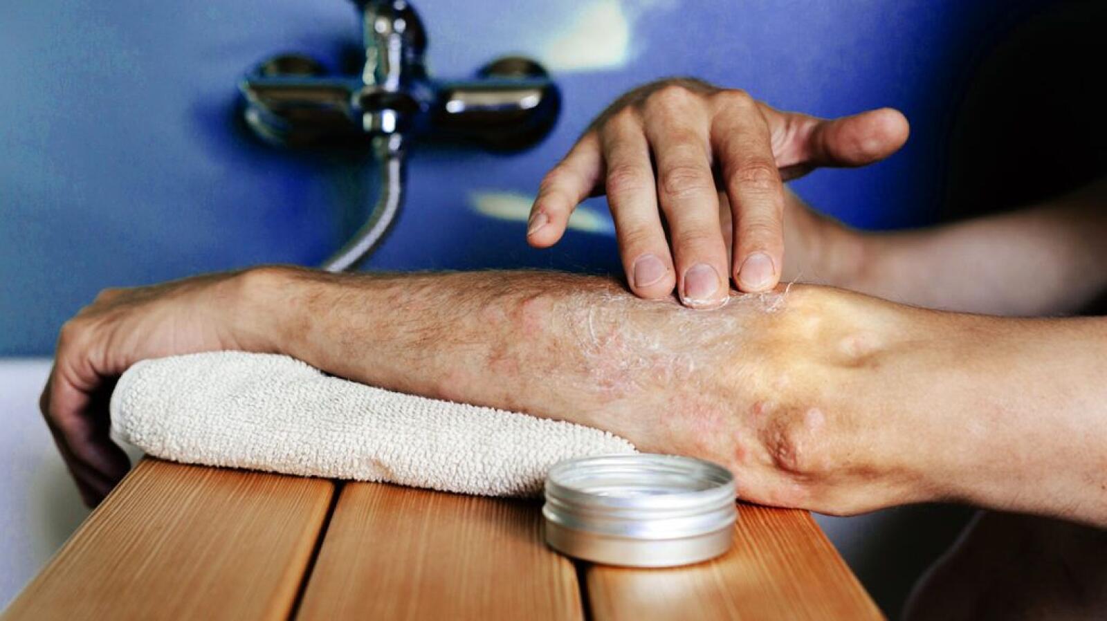 Ulcerative Colitis Rashes: Skin Conditions, Symptoms, Treatment