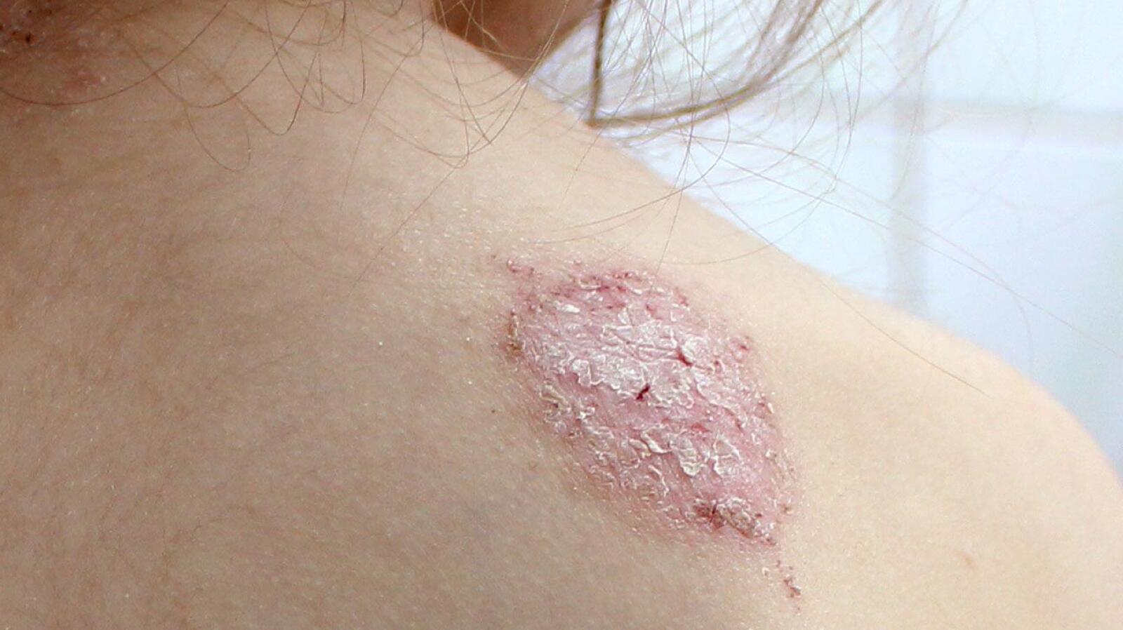 How to Care for Discoid Eczema: Symptoms, Triggers, Treatment