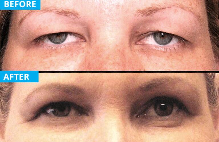 eyelid surgery patient 3