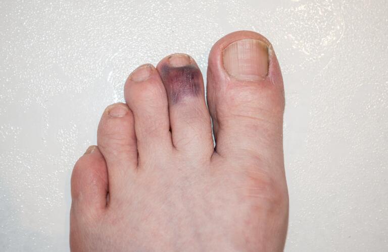 male adult left foot with stubbed and badly bruised index toe