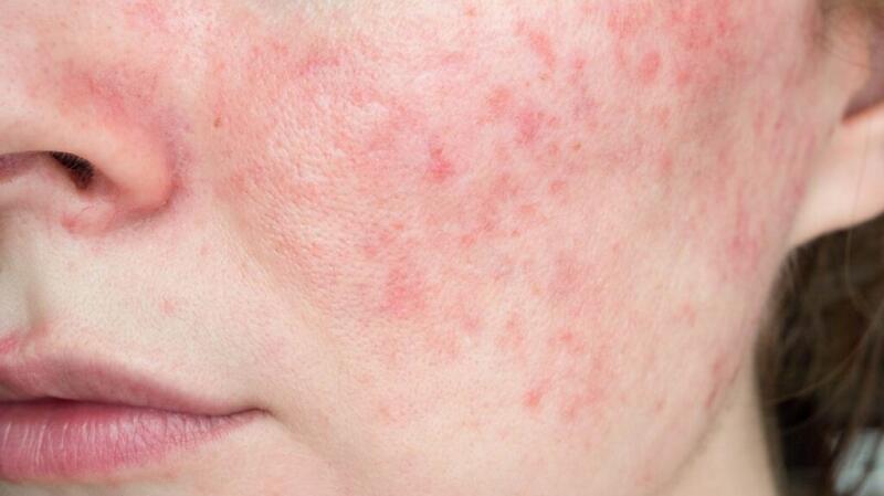 A close-up photo of a person with papulopustular rosacea on their face