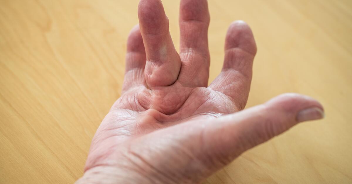 8 Surprising Dupuytren
