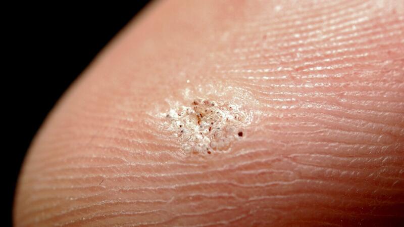 black warts on hands