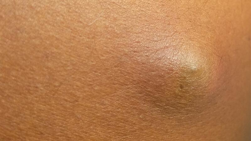 Epidermoid Cysts Causes Treatments And More epidermoid-cysts-causes-treatments-and-more