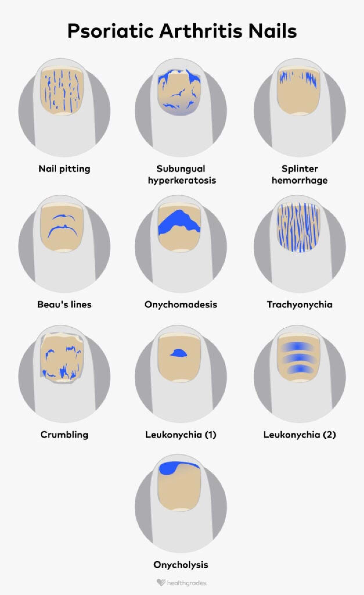 Psoriatic Arthritis Nails Symptoms Treatment And More Psoriatic Arthritis Nails Symptoms Treatment And More