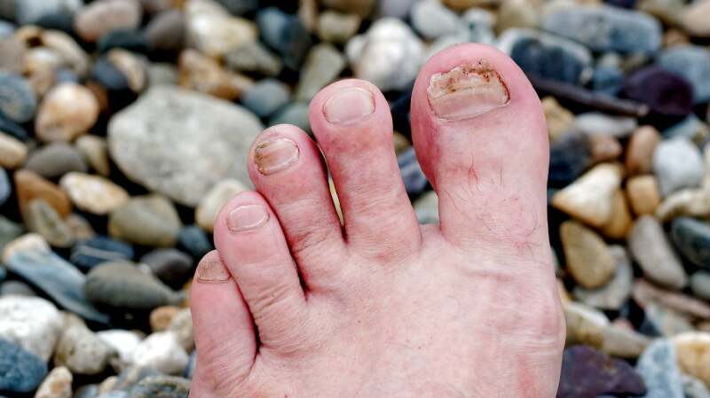 Crystal Toe Toenail Discoloration: Causes, Related Symptoms, Treatments