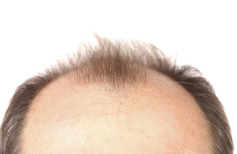 Male Pattern Baldness Treatment Options Lllt For Hair Loss In Men