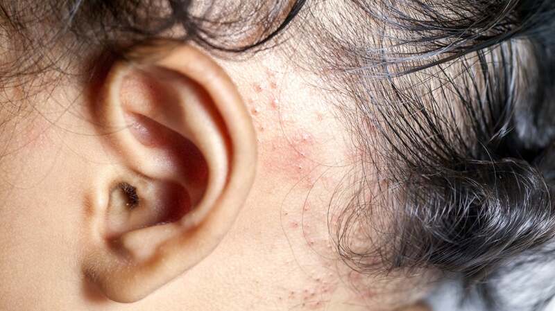 A medical image of allergic dermatitis.