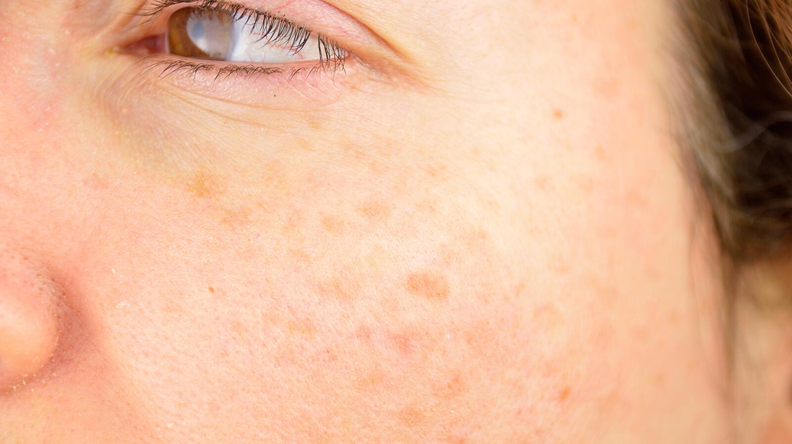 Liver Spots Causes Symptoms Treatments And More 