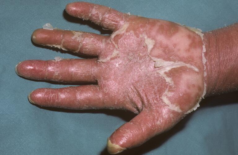 erythrodermic psoriasis on palm of hand