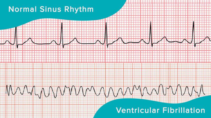 Ventricular fibrillation compared to normal sinus rhythm