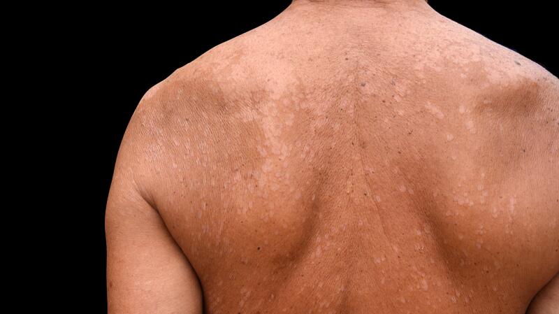 Tinea Versicolor: Symptoms, Causes, and Treatment