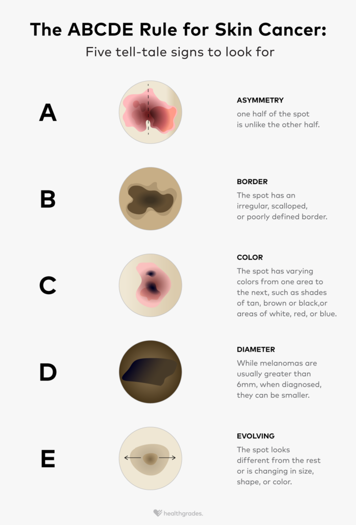 Doctors use the ABCDE characteristics of skin damage to diagnose and classify skin cancer.