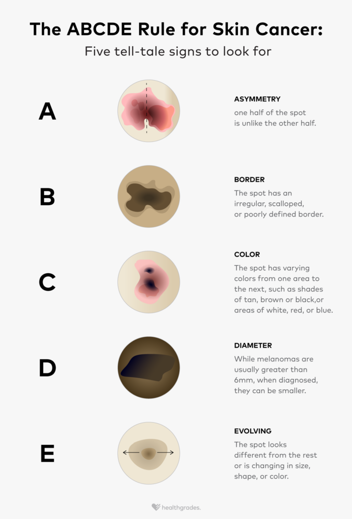 Abcdes Of Skin Cancer Melanoma Symptoms