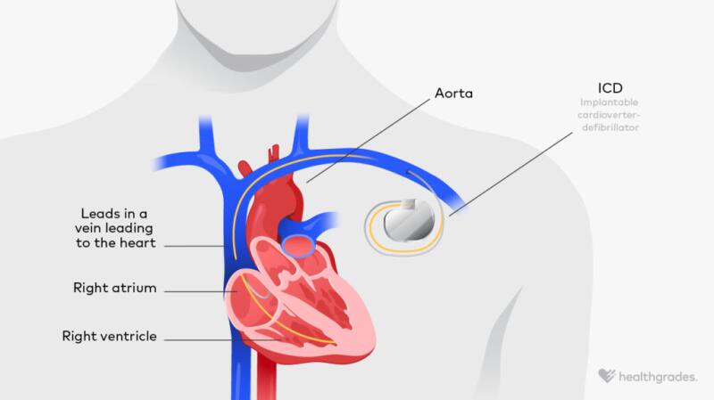 illustration of a dual chamber implantable cardioverter-defibrillator (ICD)
