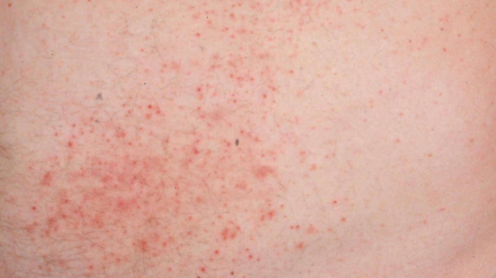 Dermatitis Herpetiformis (Gluten Rash): Everything to Know