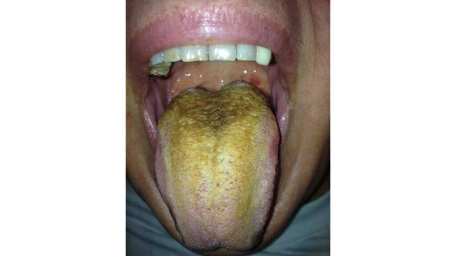 Yellow Tongue Causes, Treatments, Prevention