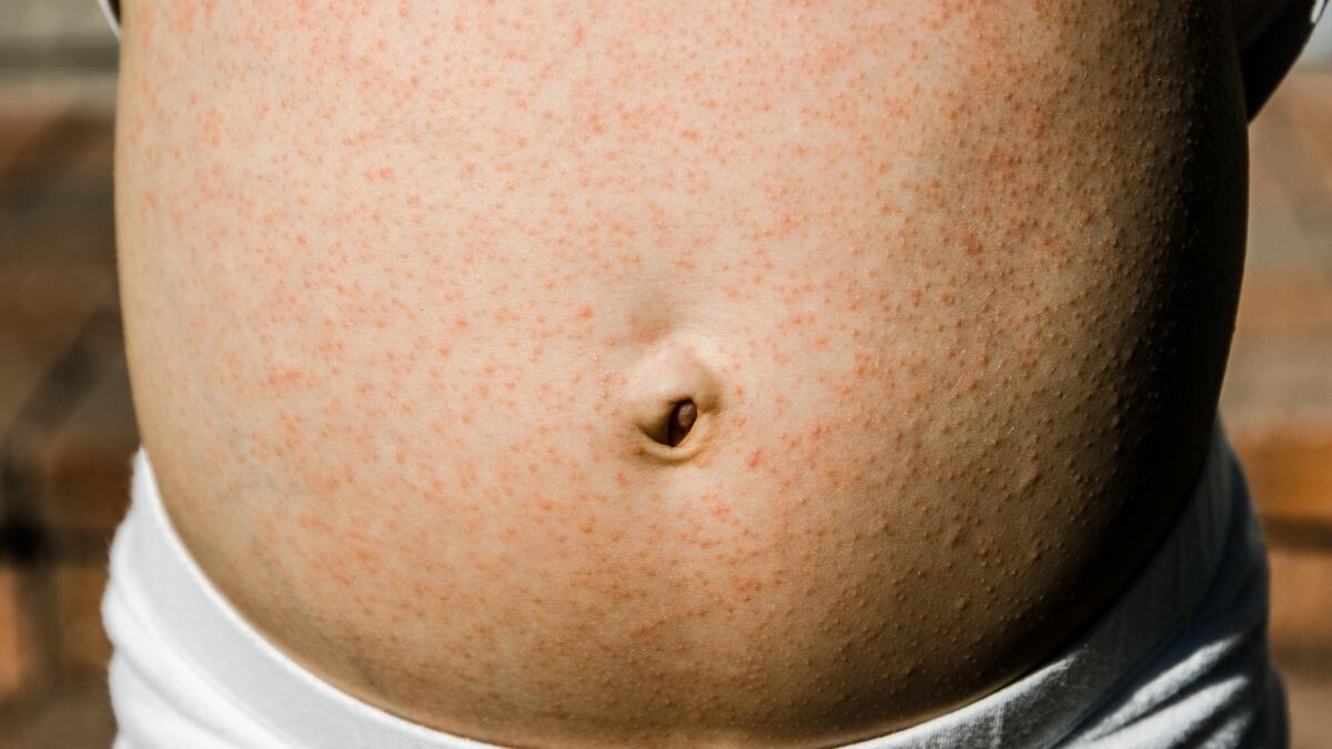 small dry, non itchy rash on breast ***pic included - June 2023