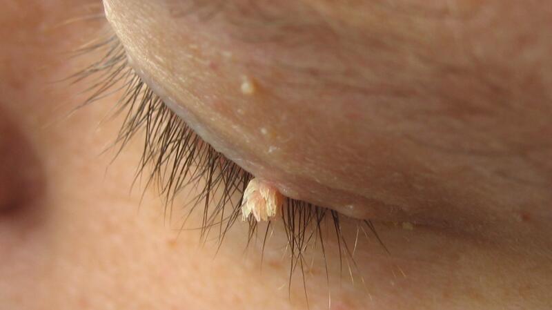 Warts Symptoms Causes Removal And More 