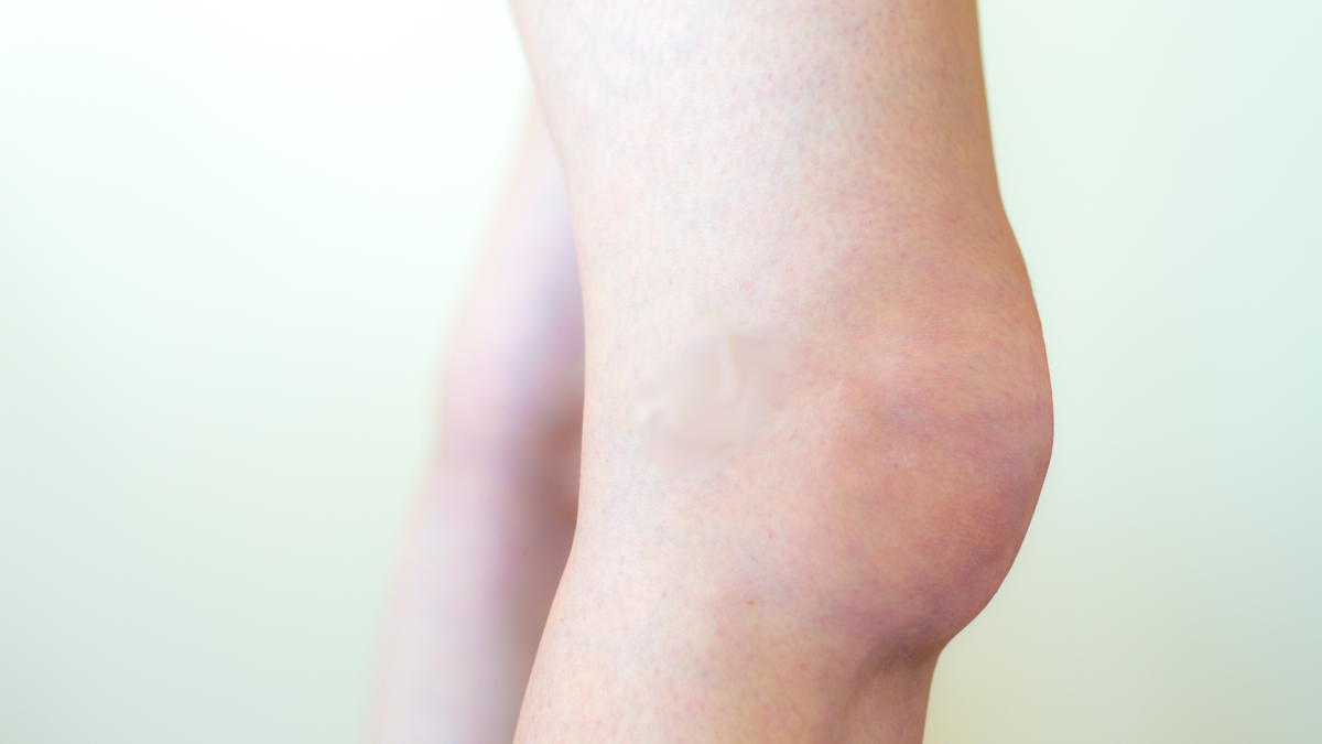 Knee Swelling - Symptoms, Causes, Treatments