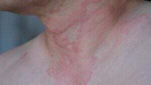 Subside Redness Skin Redness: Causes, Other Symptoms, and Treatments