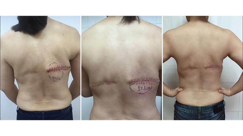 Plastic Surgery Case Study - Waist Reduction In A Female Body Builder Using  Combined Rib Removal and Lat Muscle Resection - Explore Plastic Surgery