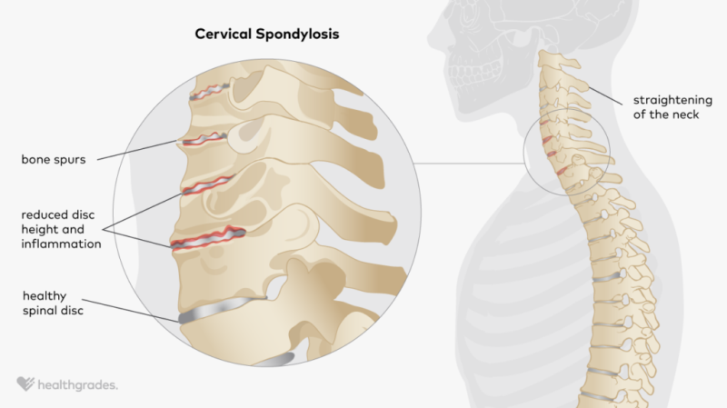 This illustration shows the neck and different areas of the spine. It also shows differences between a healthy spine and a spine affected by cervical spondylosis.
