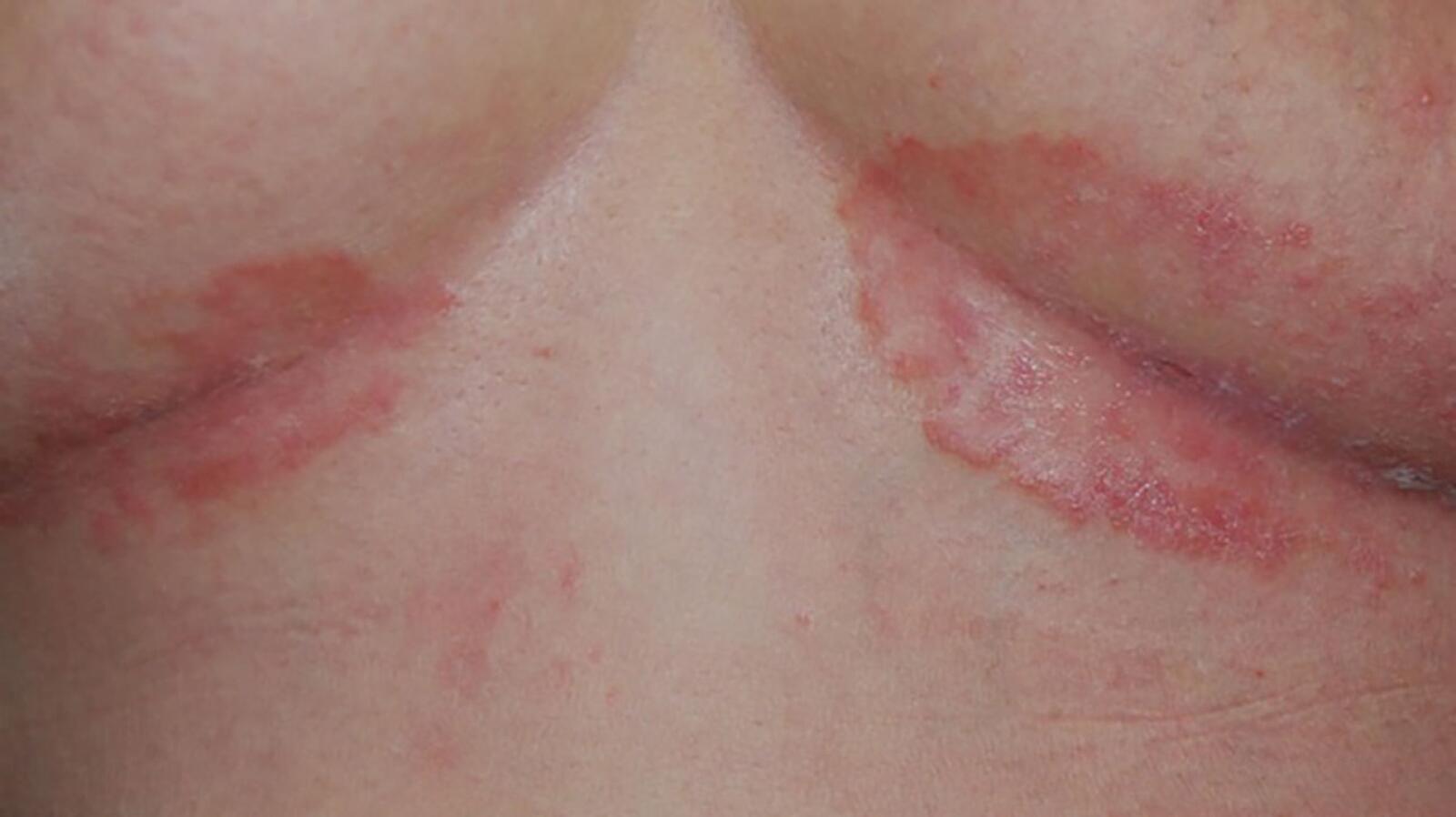 Psoriasis Symptoms, Causes, Pictures, and Treatments