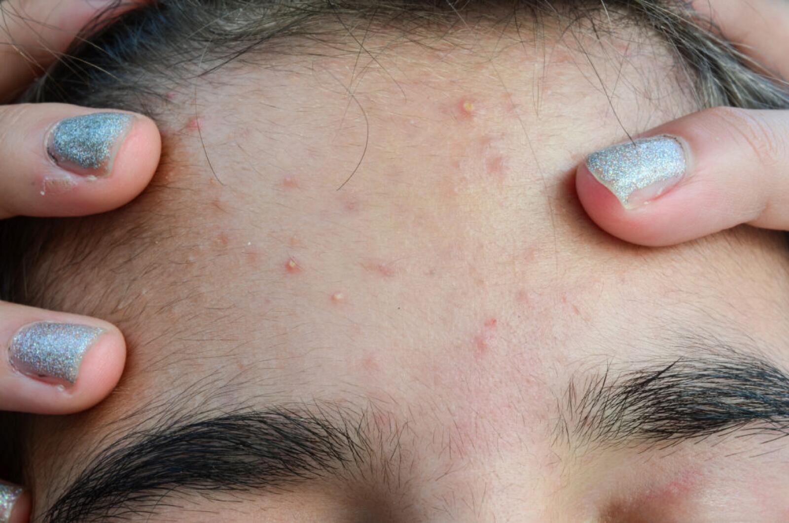 Forehead Acne Treatments And Prevention forehead-acne-treatments-and-prevention