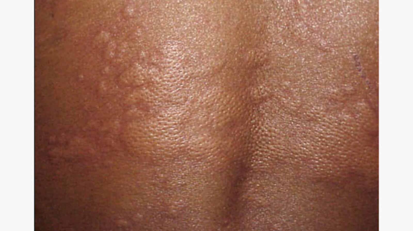 Breaking Out in Hives for No Apparent Reason What Causes Hives?