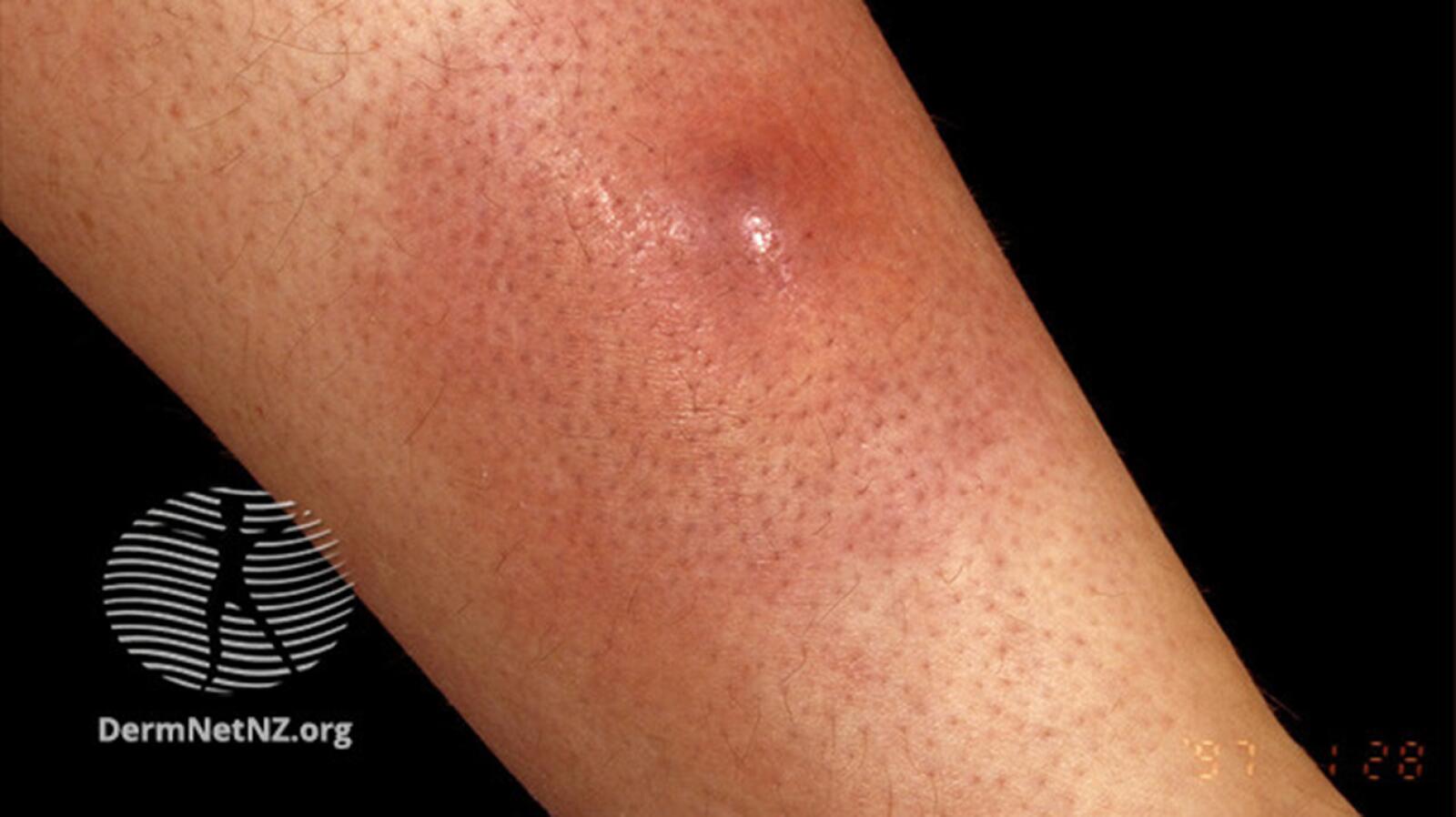 Boil: Causes Symptoms Treatments and More Boil: Causes Symptoms Treatments and More