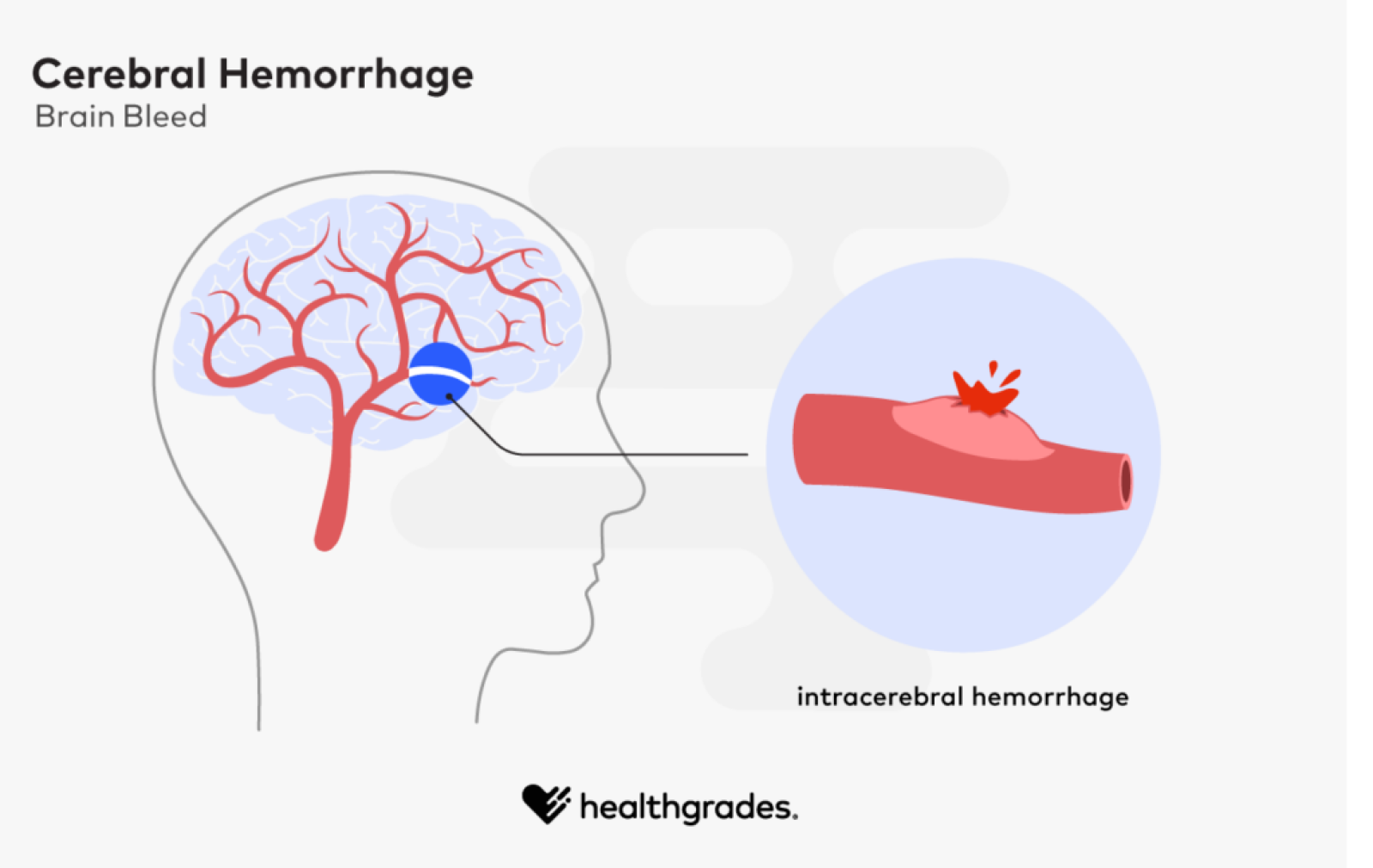 Cerebral Hemorrhage Brain Bleed Symptoms Causes Treatments 9094