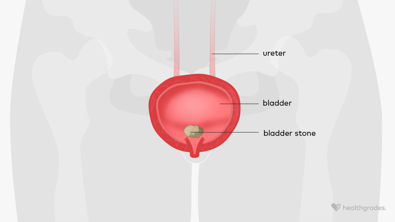 Bladder Fast Bladder Stones: Symptoms, Causes, and Treatment
